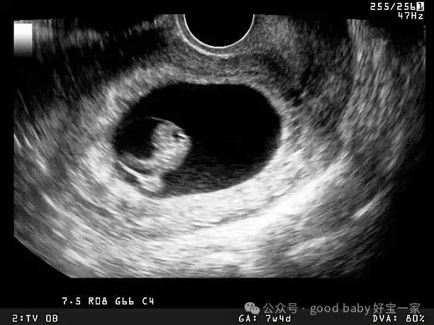 ultrasound showing early stage of embryo development - 胚胎 個照片及圖片檔